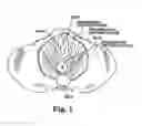 Fig. 02 - LEVATOR FOR REPAIR OF PERINEAL PROLAPSE