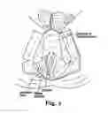 Fig. 04 - LEVATOR FOR REPAIR OF PERINEAL PROLAPSE