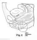 Fig. 07 - LEVATOR FOR REPAIR OF PERINEAL PROLAPSE