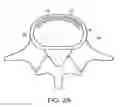 Fig. 03 - In-situ formed intervertebral fusion device and method