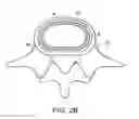 Fig. 04 - In-situ formed intervertebral fusion device and method