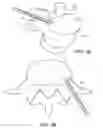Fig. 09 - In-situ formed intervertebral fusion device and method