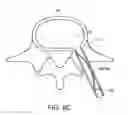Fig. 16 - In-situ formed intervertebral fusion device and method
