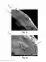Fig. 04 - Graft devices and related systems and methods