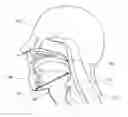 Fig. 01 - PARTIALLY ERODABLE SYSTEMS FOR TREATMENT OF OBSTRUCTIVE SLEEP APNEA