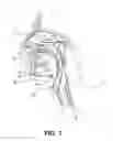 Fig. 02 - PARTIALLY ERODABLE SYSTEMS FOR TREATMENT OF OBSTRUCTIVE SLEEP APNEA