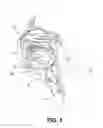 Fig. 03 - PARTIALLY ERODABLE SYSTEMS FOR TREATMENT OF OBSTRUCTIVE SLEEP APNEA