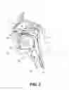 Fig. 04 - PARTIALLY ERODABLE SYSTEMS FOR TREATMENT OF OBSTRUCTIVE SLEEP APNEA