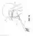 Fig. 08 - PARTIALLY ERODABLE SYSTEMS FOR TREATMENT OF OBSTRUCTIVE SLEEP APNEA