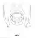 Fig. 23 - PARTIALLY ERODABLE SYSTEMS FOR TREATMENT OF OBSTRUCTIVE SLEEP APNEA