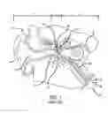 Fig. 02 - Eustachian tube dilation balloon with ventilation path