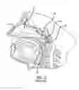 Fig. 03 - Eustachian tube dilation balloon with ventilation path