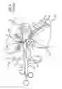 Fig. 05 - Eustachian tube dilation balloon with ventilation path