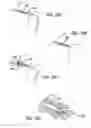 Fig. 19 - Eustachian tube dilation balloon with ventilation path