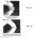 Fig. 02 - Demineralized Bone Matrix