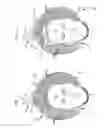 Fig. 03 - Securing a TMS coil to the patient's head