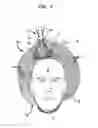 Fig. 04 - Securing a TMS coil to the patient's head