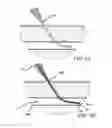 Fig. 09 - DEVICE AND METHOD FOR SEALING BLOOD VESSELS