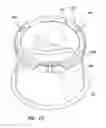 Fig. 09 - Hand access laparoscopic device