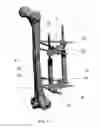 Fig. 02 - Elongated pin for an external modular fixation system for temporary and/or permanent fixation applications and external modular fixation system