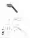 Fig. 02 - Method and device for restabilization with axial rotation of the atlantoaxial junction
