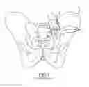 Fig. 02 - Methods of fusing a sacroiliac joint