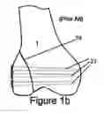 Fig. 03 - Knee hinge fixation apparatus and method for application thereof