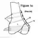 Fig. 04 - Knee hinge fixation apparatus and method for application thereof