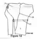 Fig. 05 - Knee hinge fixation apparatus and method for application thereof