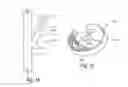 Fig. 09 - Methods and apparatus for filtering a body lumen
