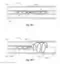 Fig. 16 - Methods and apparatus for filtering a body lumen