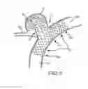 Fig. 06 - Vascular remodeling device