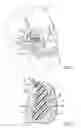 Fig. 02 - Malar implant with dual-plane adhesion