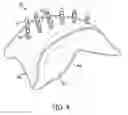 Fig. 04 - Malar implant with dual-plane adhesion