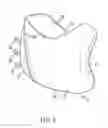 Fig. 05 - Malar implant with dual-plane adhesion