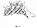 Fig. 06 - Malar implant with dual-plane adhesion