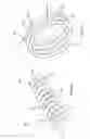 Fig. 06 - Thermally activated shape memory spring assemblies for implant expansion