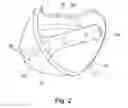 Fig. 03 - Prosthesis socket