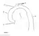 Fig. 02 - Customized aortic stent device and method of making the same