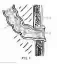 Fig. 02 - Device for a Temporary Ileostomy or Urostomy Closure