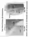 Fig. 13 - Apparatus and methods for preventing or treating failure of hemodialysis vascular access and other vascular grafts