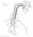 Fig. 01 - Method of detecting endotracheal tube misplacement