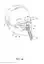 Fig. 40 - Nasal interfaces for respiratory therapy
