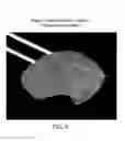 Fig. 08 - Neurosurgical apparatus and method