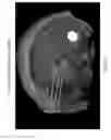 Fig. 09 - Neurosurgical apparatus and method