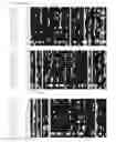 Fig. 06 - Albumin variants