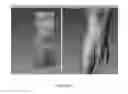 Fig. 02 - METHODS FOR DETECTING LYMPHEDEMA