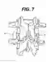 Fig. 06 - Configured and sized cannula