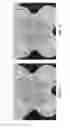 Fig. 76 - Method and apparatus for restricting flow through an opening in the side wall of a body lumen, and/or for reinforcing a weakness in the side wall of a body lumen, while still maintaining substantially normal flow through the body lumen