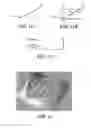 Fig. 09 - Methods for Determining Meniscal Size and Shape and for Devising Treatment